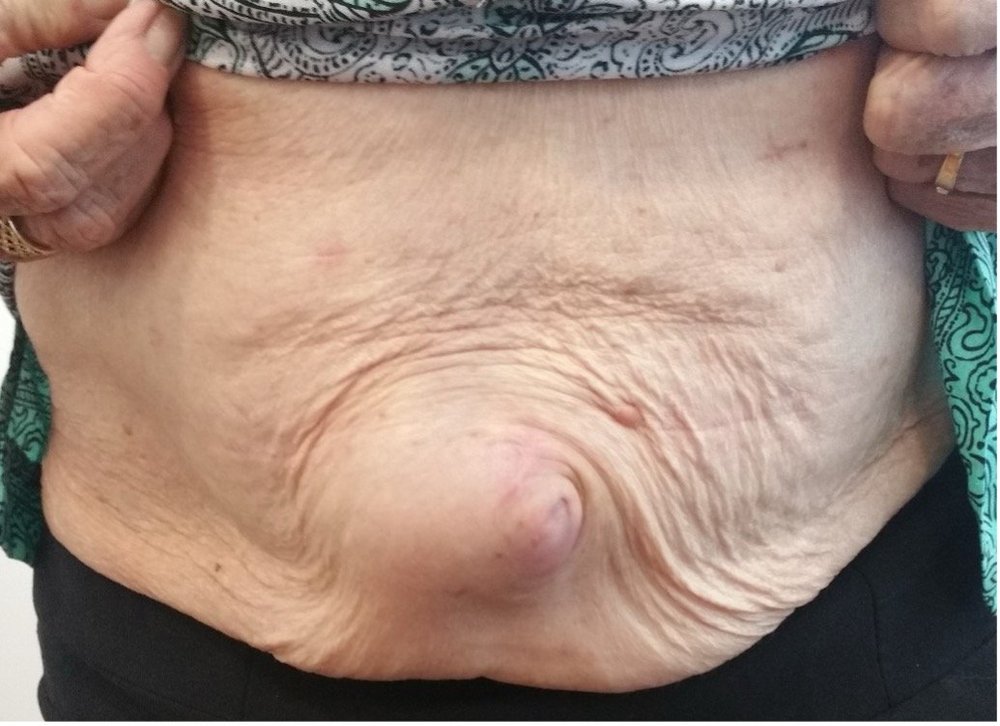 Clinical photograph showing an example of an incisional hernia