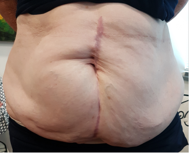 Clinical photograph before Fleur-de-Lis abdominoplasty