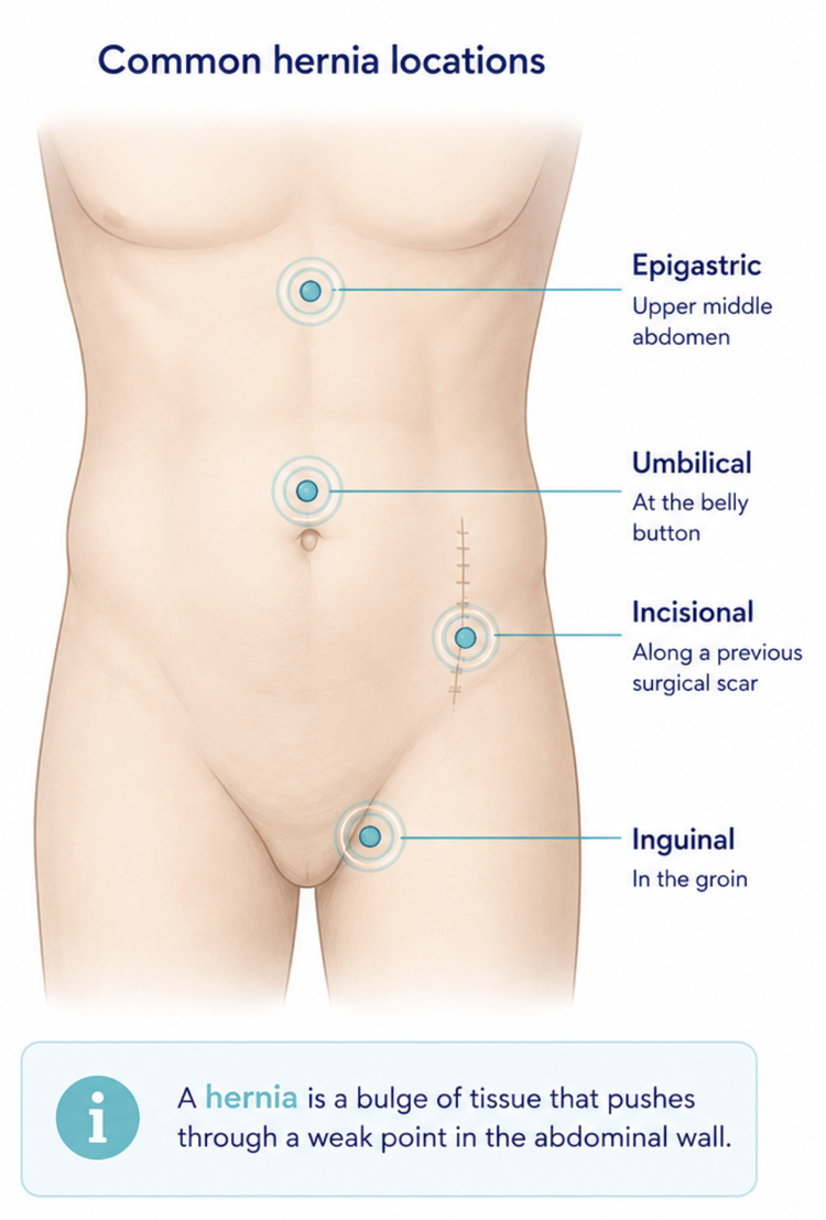 Illustration showing common locations where abdominal wall hernias can occur