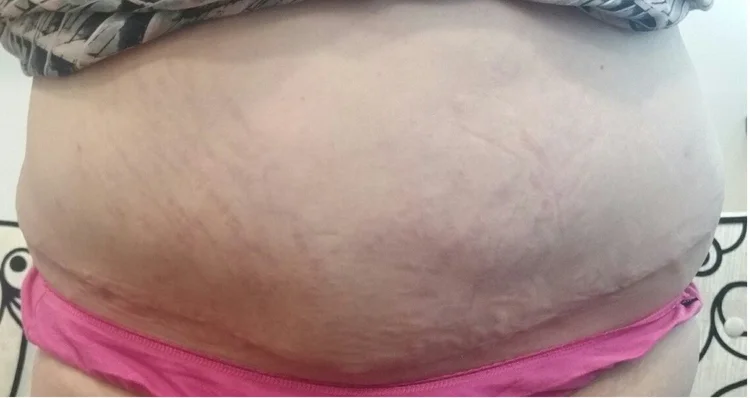 Postoperative example after abdominoplasty with the belly button removed