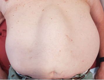 Clinical example showing abdominal bulging associated with rectus diastasis