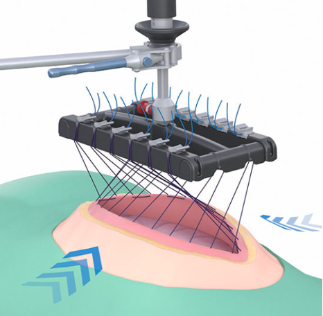Fasciotens device used to apply controlled traction to the abdominal wall