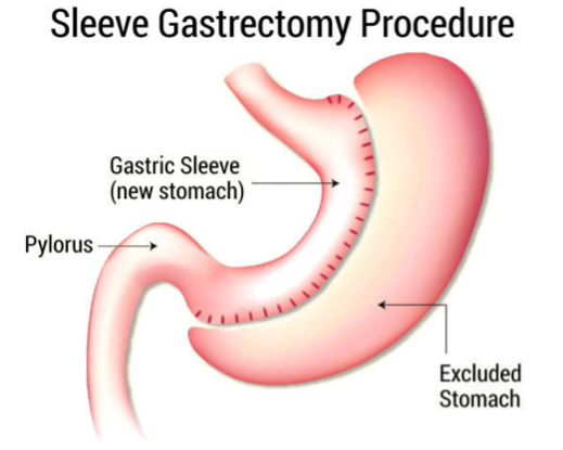 Diagram of sleeve gastrectomy showing the narrow gastric sleeve and the stomach tissue that is removed