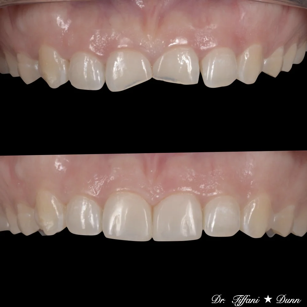 Before and after images of a person's upper front teeth showing dental restoration, with smoother, more uniform teeth in the after picture.