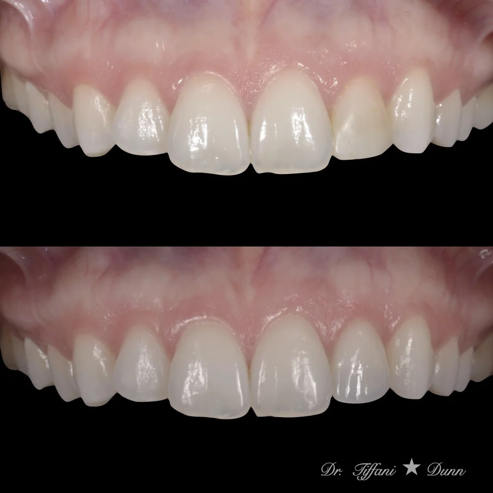 Close-up of a person's upper front teeth showing before and after dental treatment, with the bottom image credited to Dr. Tiffani Dunn.
