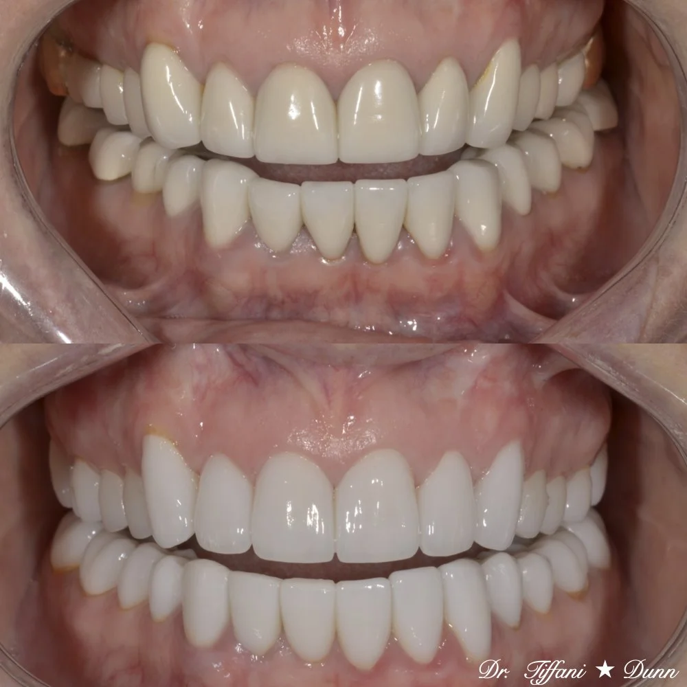 Close-up of a person's teeth before and after dental cosmetic restoration, showing improved alignment and whiter appearance in the after image.