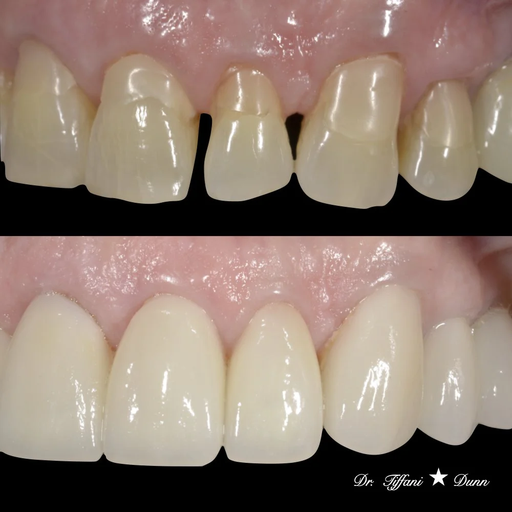 Before and after close-up photos of teeth showing dental restoration work, with healthy and improved appearance.