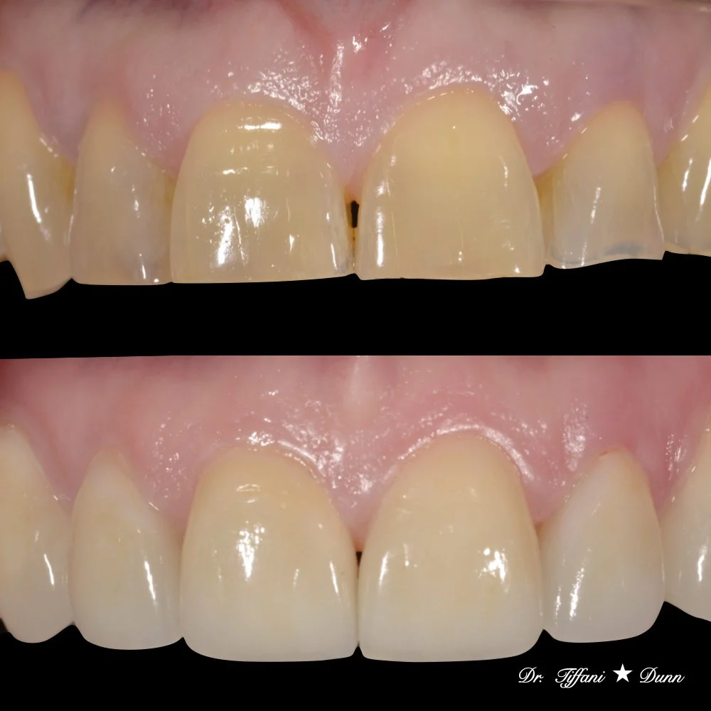 Close-up of a person's upper front teeth before and after dental whitening, with the after teeth appearing whiter and cleaner.