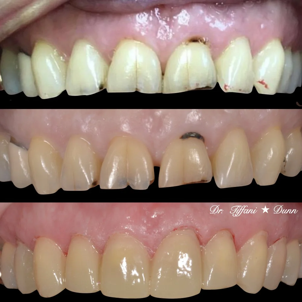 Close-up of a person's upper front teeth showing dental repair progress through three stages: damaged teeth with chips and stains, after initial cleaning and preparation, and after dental restorations with improved appearance.