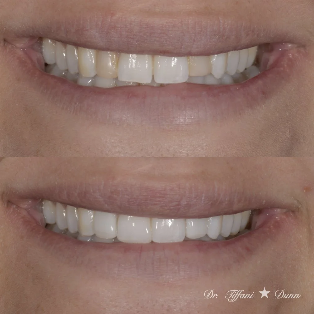 Close-up of a smiling person's mouth before and after dental treatment, showing improved teeth whiteness.