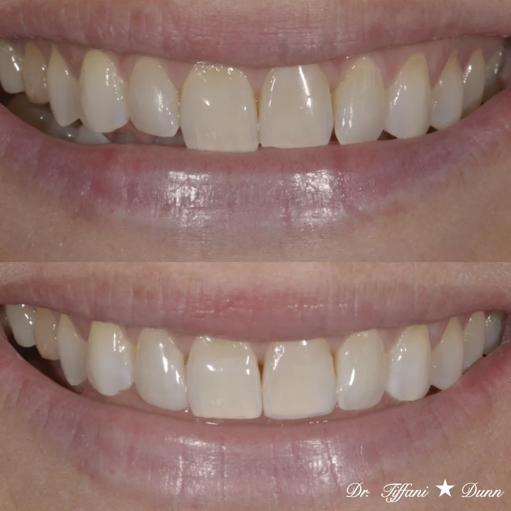 Close-up of a person's smiling mouth showing teeth before and after dental treatment, with a natural lip line and a signature in the bottom right corner reading 'Dr. Tiffani Dunn'.