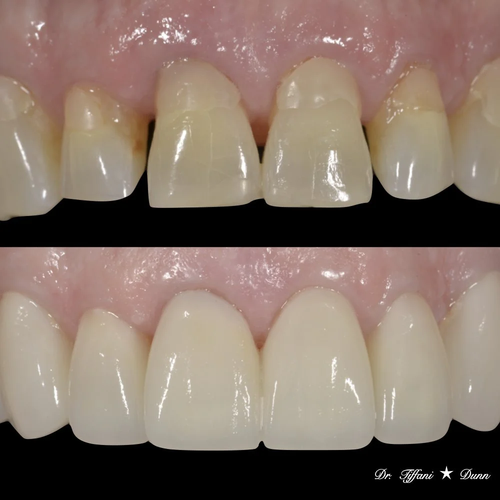 Close-up of upper front teeth before and after dental restoration, showing improved appearance and color after treatment.