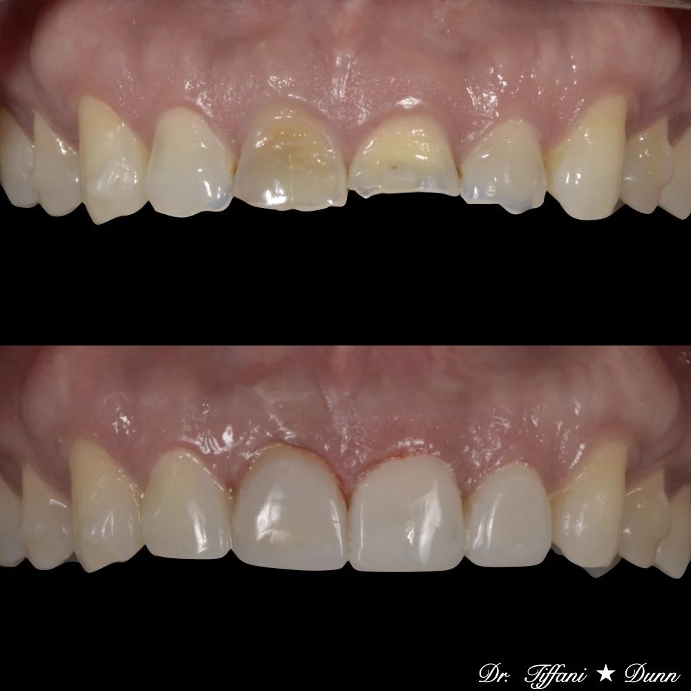 Comparison of teeth before and after dental cleaning or whitening, showing improved appearance of the teeth.