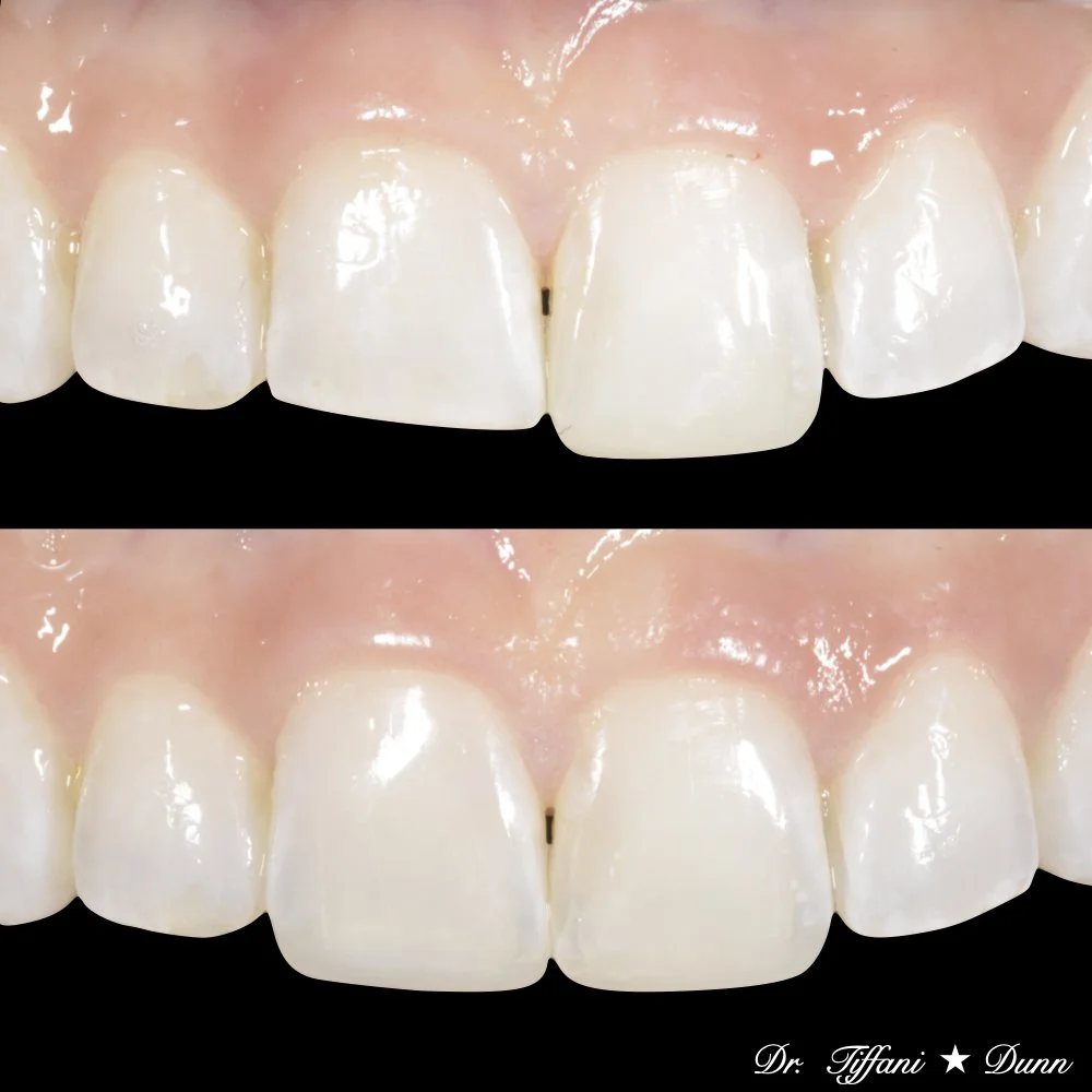 Close-up of upper front teeth showing a dental procedure, with the upper teeth appearing whiter and more uniform. The bottom image is similar, with the teeth also appearing whiter and more evenly shaped. Both images are likely showing before and afte