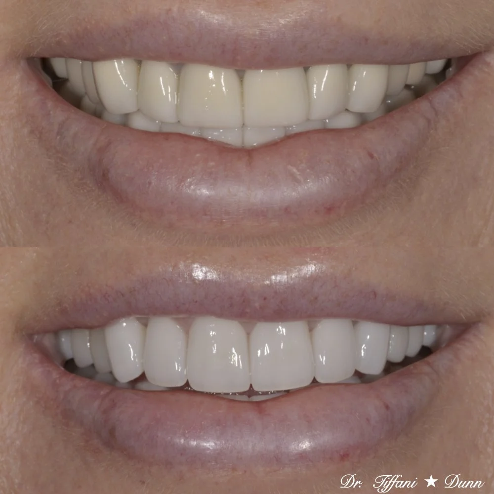 Close-up of a smile showing before and after dental crowns, with the lower image displaying bright, white teeth.