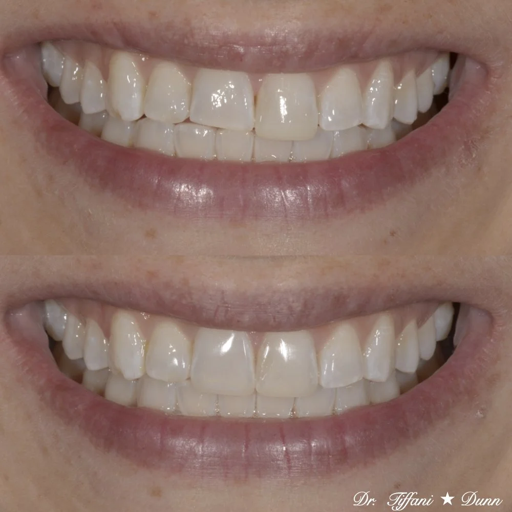 Comparison of a person's teeth before and after teeth whitening treatment, showing brighter, whiter teeth in the after image.