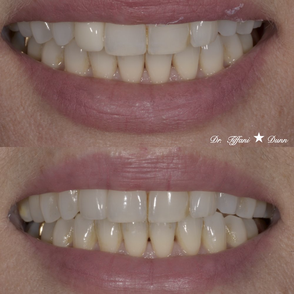 Close-up of a person's smile showing dental work, with the top image showing teeth with visible staining and the bottom image showing teeth that have been whitened or treated.