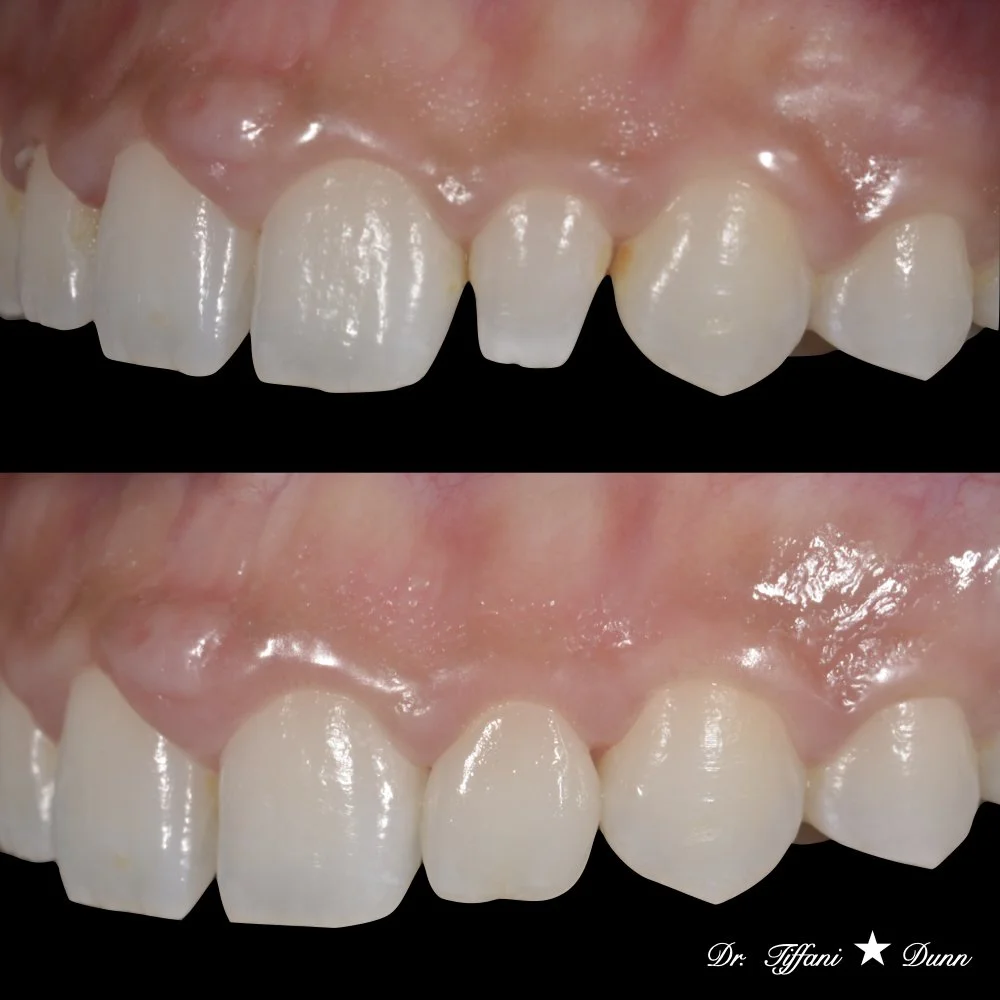 Close-up of front teeth showing before and after dental work, with soft tissue gums above. The after image shows improved teeth alignment and appearance. Signed by Dr. Tiffani Dunn.