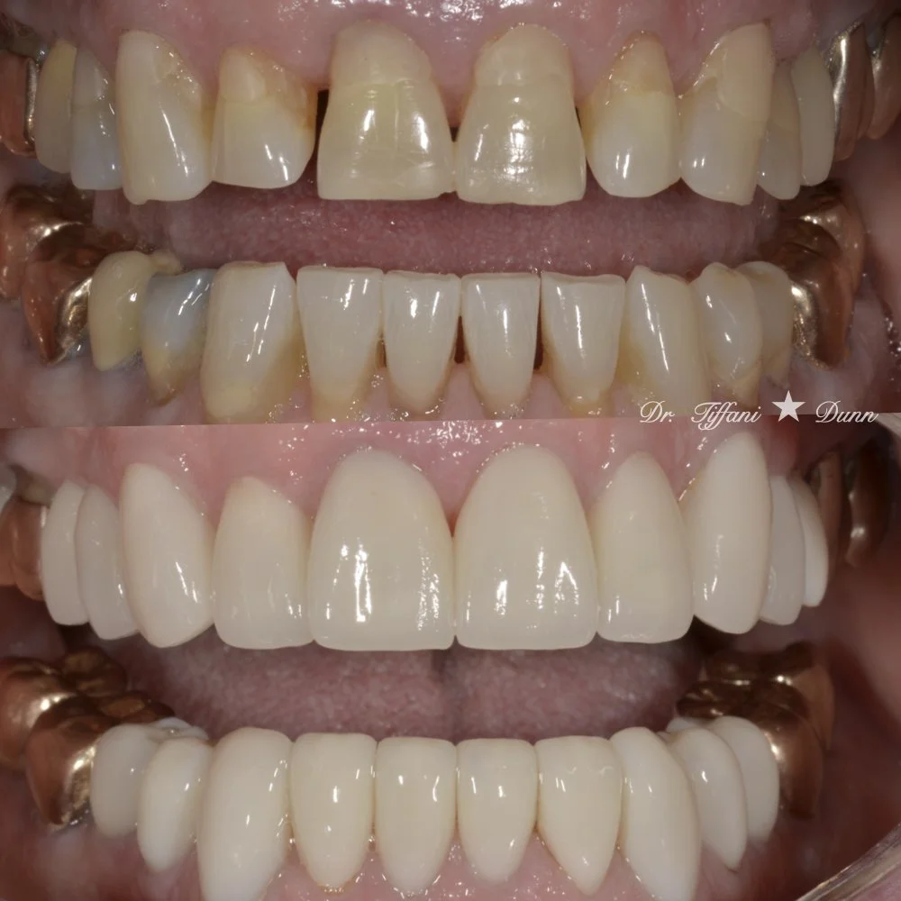 Progression of dental restoration showing before, during, and after images of teeth whitening and dental crowns.