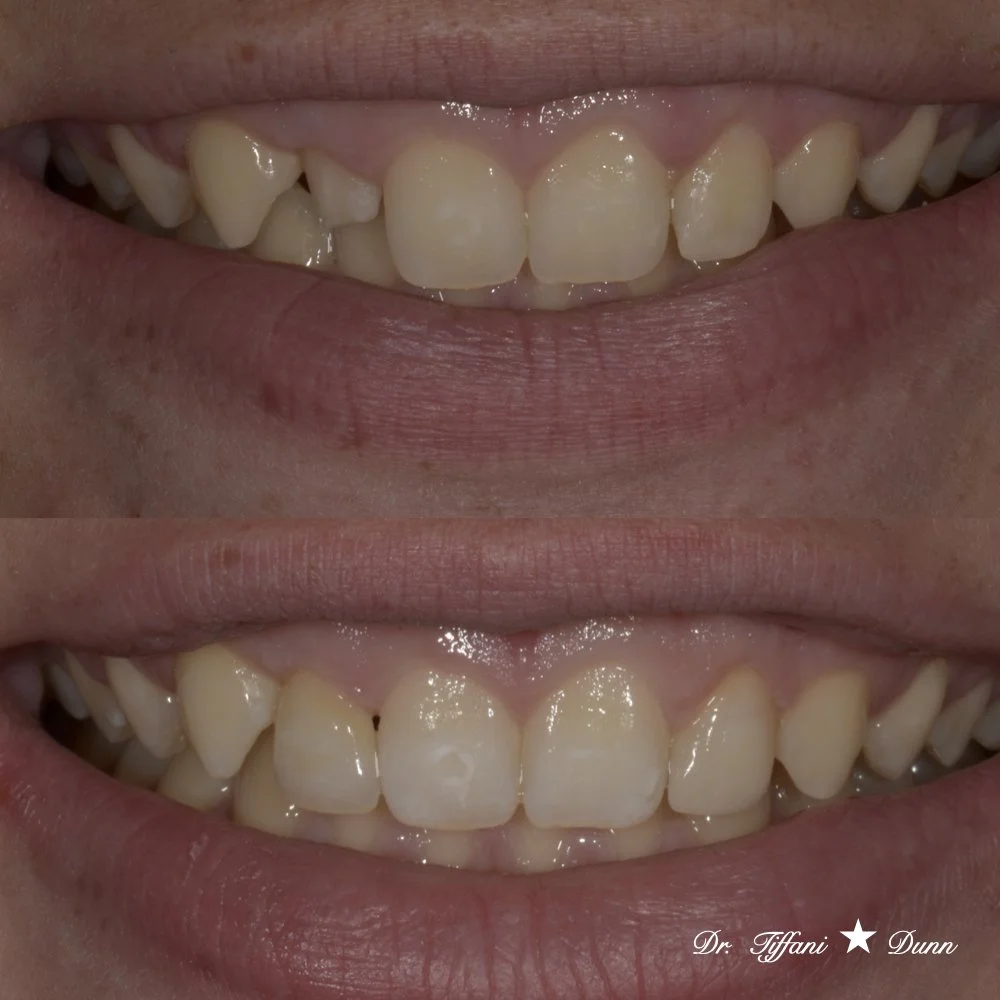 Close-up photograph of a person's upper front teeth showing crowding and irregular spacing, with a faint smile.