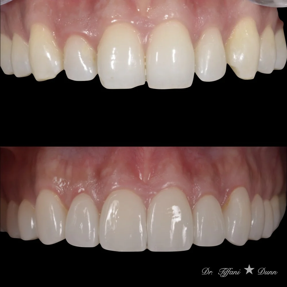Comparison of teeth before and after dental treatment showing improved appearance of teeth with veneers or whitening by Dr. Tiffani Dunn.