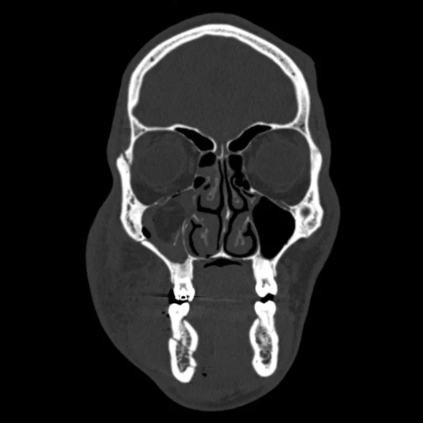 Medical scan showing a detailed cross-section of a human skull, facial bones, and nasal cavity.