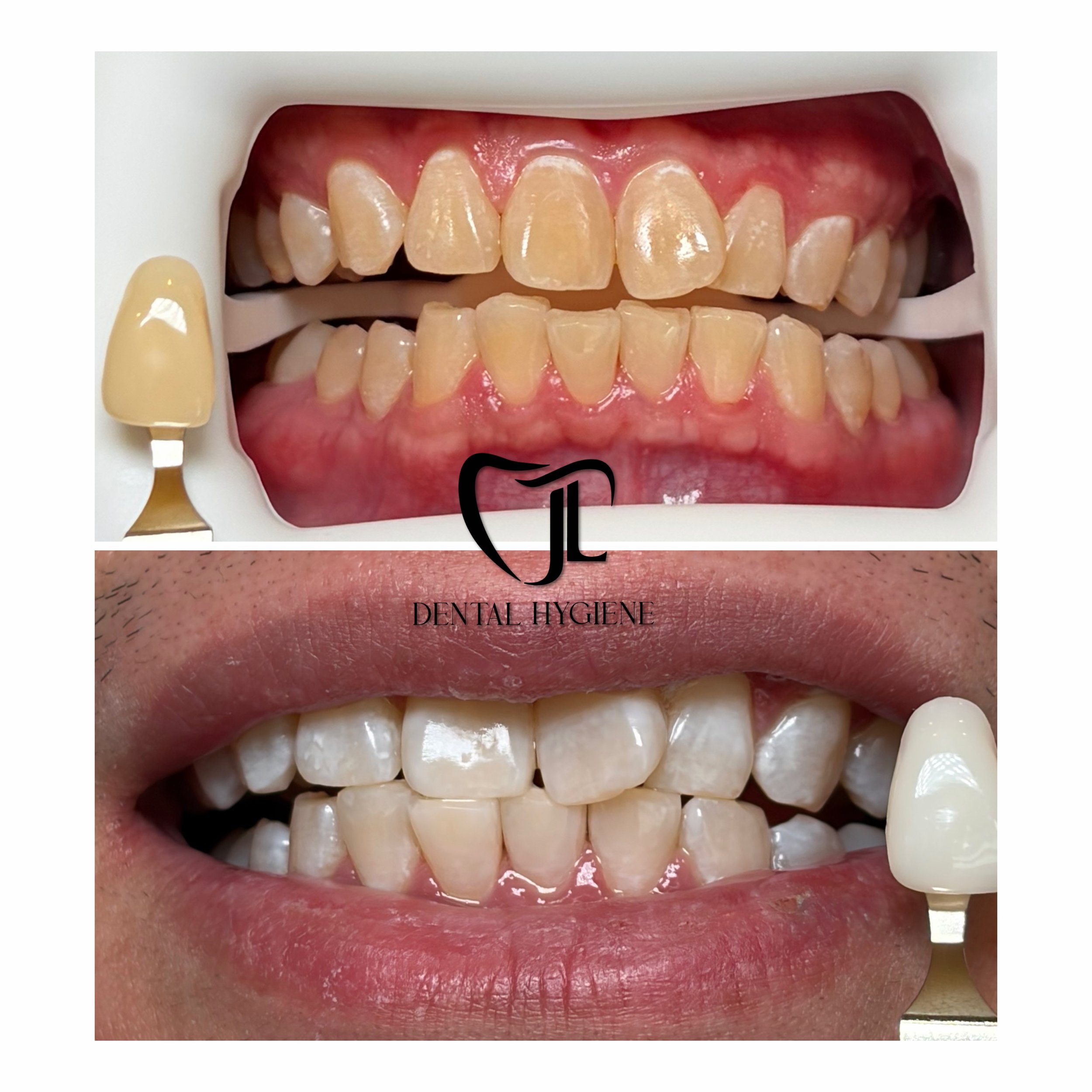 ✨Acheived in one session, right after teeth cleaning. With 3 applications of our Signature Gel. We are very happy with the results as was the patient's first ever teeth whitening treatment! ✨

* Image is for informational purposes only. With teeth wh