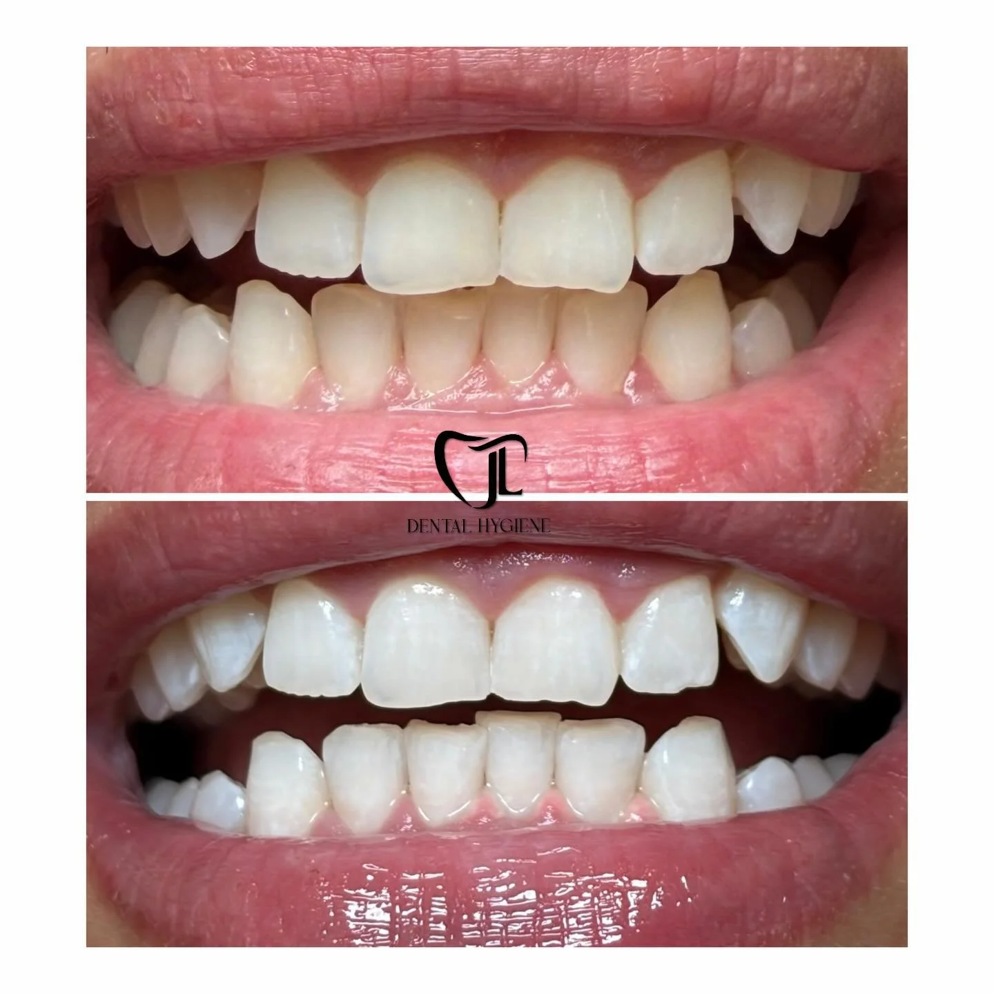 ✨Ultra Whitening Treatment ✨ 
Noticeable results in one session 😍

#teethwhitening #beforeandafter 

*Teeth whitening was performed on JL Dental Hygiene's patients. Images are for informational purposes only. Please note that results vary, and not a