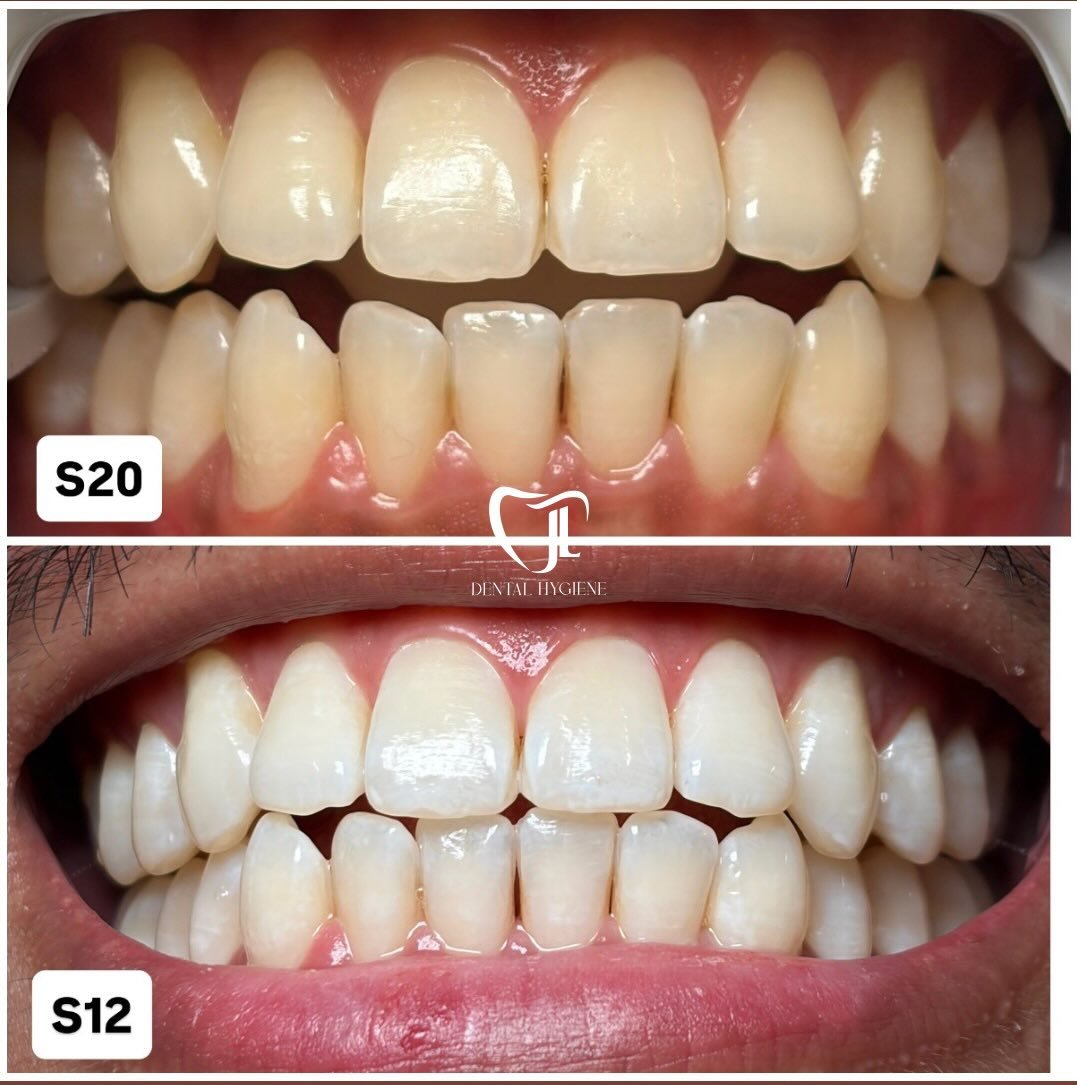 1st Photo: Signature Whitening ✨Shade 20 ➡️ 12 ✨

☝🏻A slight shade rebound occured between sessions. This is completely normal as results vary and longevity differs from person to person. 

2nd Photo: We followed up with Boost Whitening (5 weeks aft