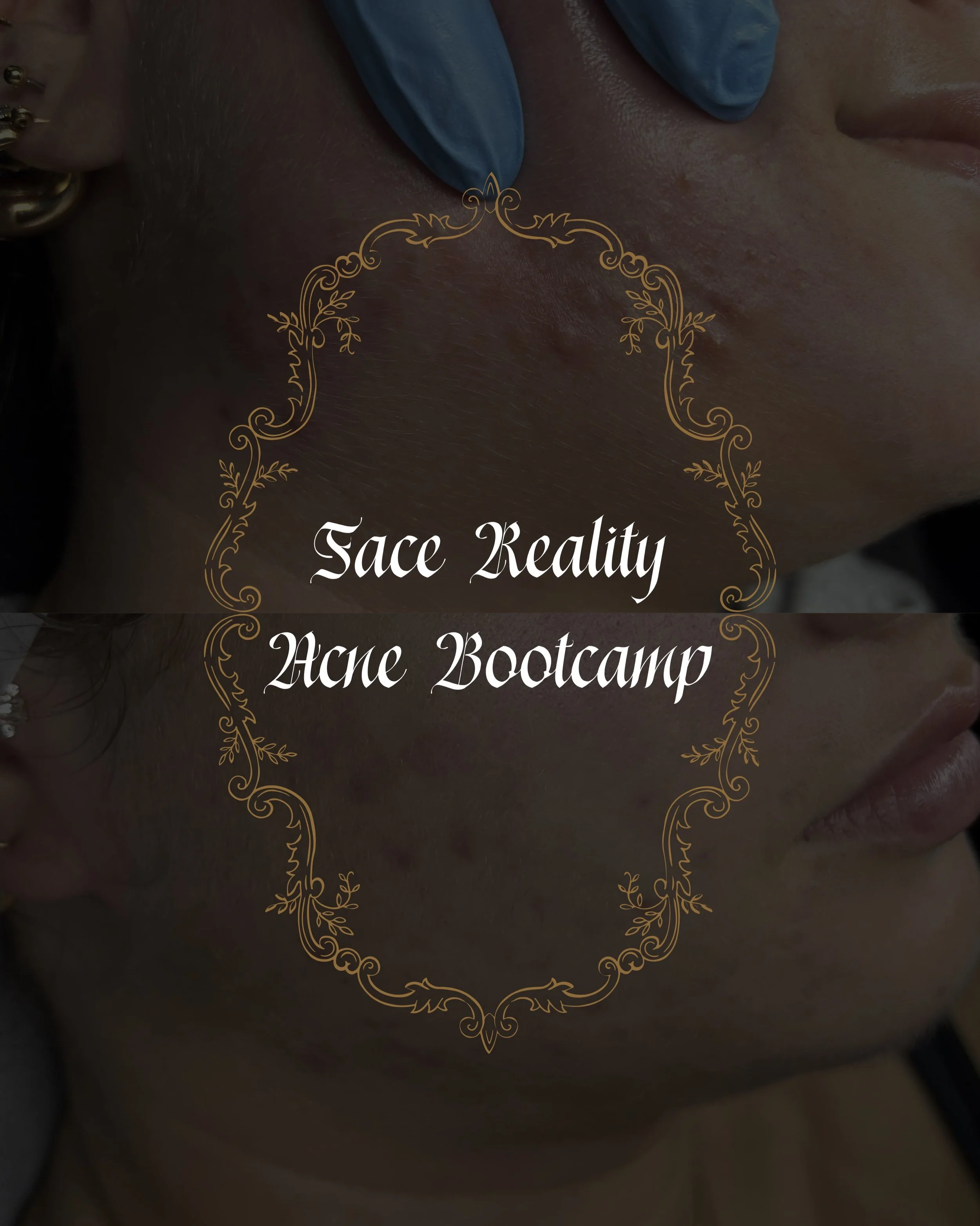 Another Acne Bootcamp B&amp;A that we&rsquo;re just so excited for🌞

Our lovely gal had some hormonal issues, acne &amp; major barrier impairment. We slowly worked to heal her barrier &amp; in turn, that slowed her acne way down resulting in healthi