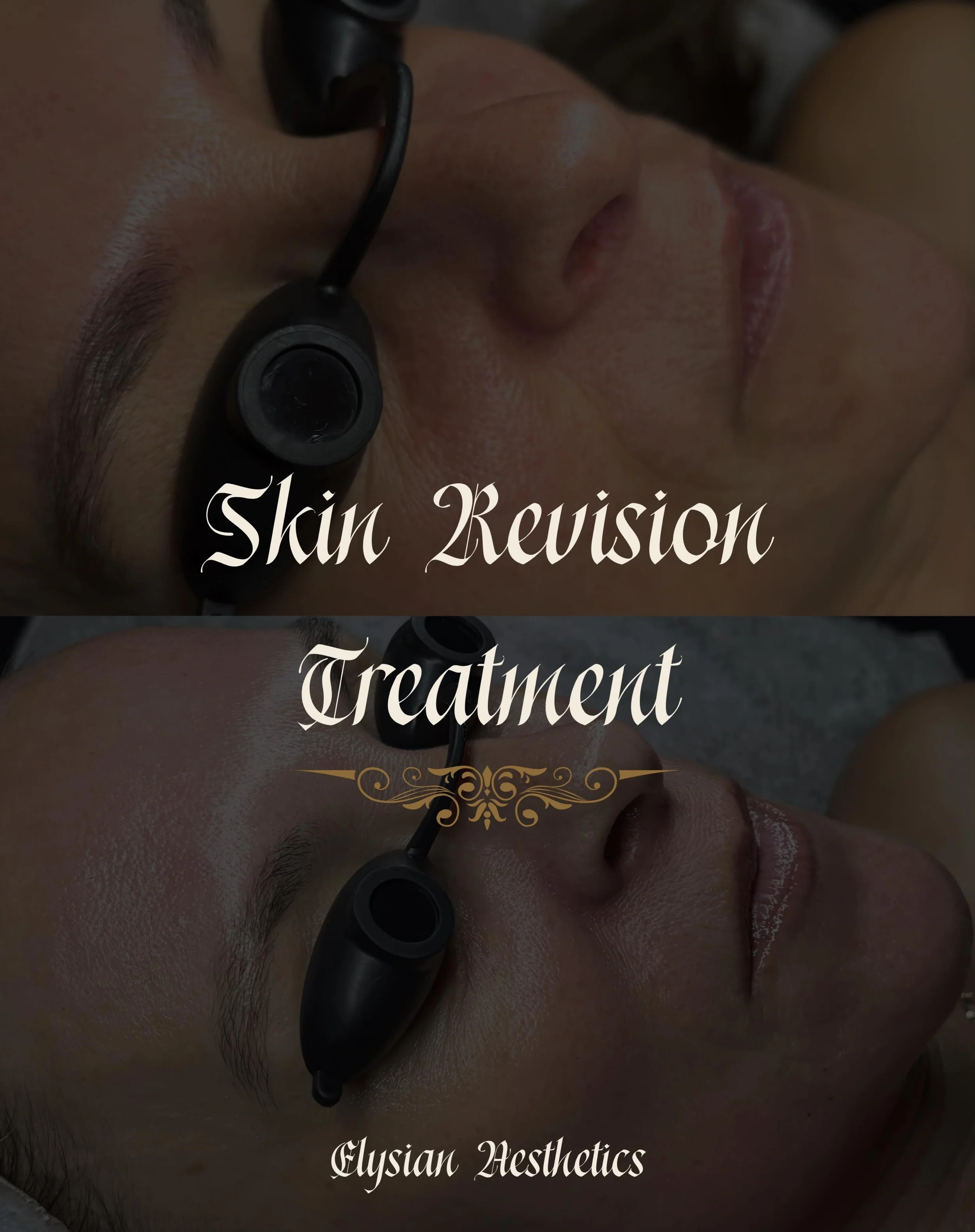 A year of Skin Revision treatments later &amp; the results speak for themselves 😻✨

My client had been struggling with rosacea that came with a lot of erythema, fine lines, dryness and overall dull skin. We did corrective &amp; barrier supportive tr