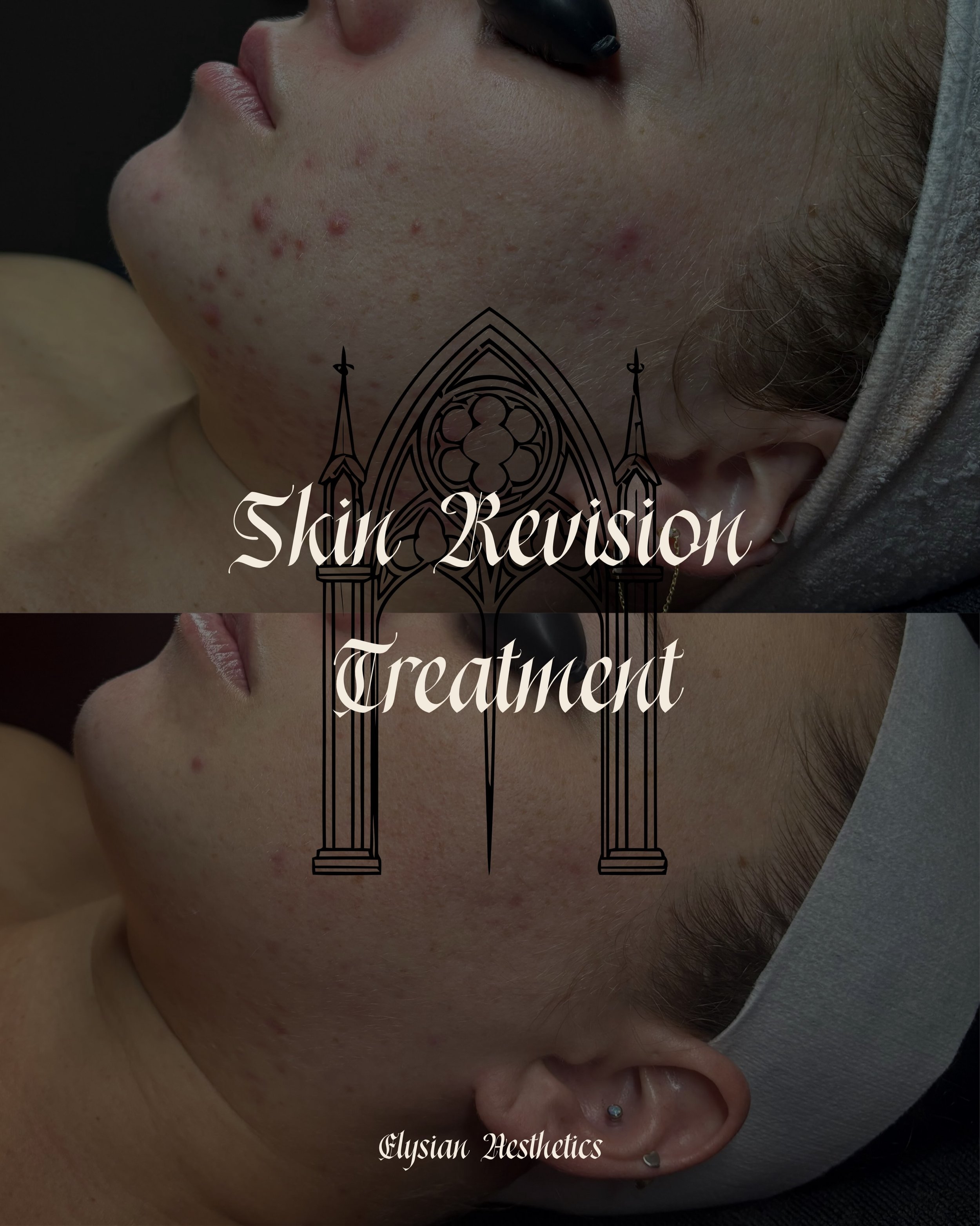 December 2025 -> June 2026🌛

I love an Acne B&amp;A😩 We have been working with this lovely lady for 6 ish months now, and we have been working to bring down inflammation &amp; acne. We have been so obsessed with her skin &amp; results! I am so i