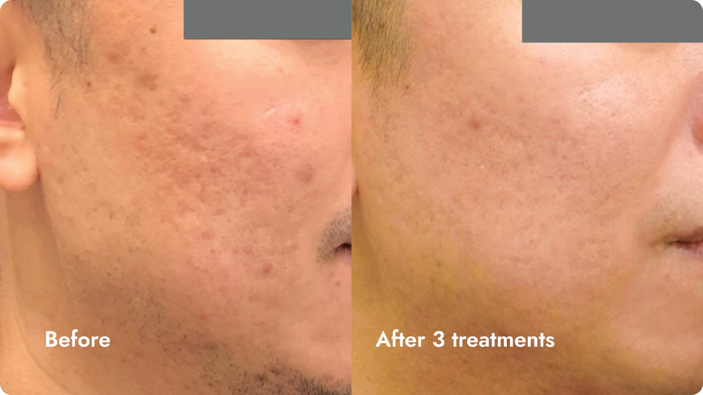 Side-by-side comparison of a person's cheek before and after three skin treatments, showing reduction in acne scars and smoother skin texture.