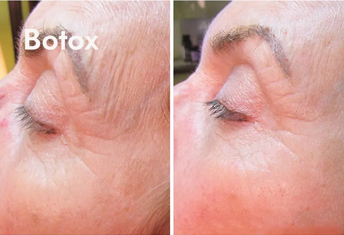 Close-up side-by-side comparison of a woman's face before and after Botox treatment, showing reduced wrinkles around the eye area.