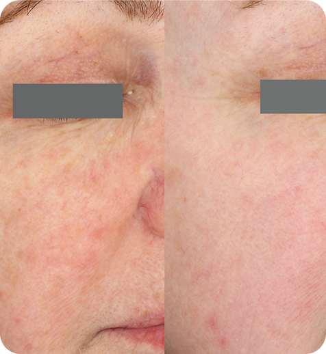 Close-up of a person's face showing before and after skin treatment, with improved skin texture and reduced redness on the right side.