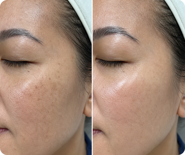 Close-up of a woman's face showing a comparison of skin with dark spots and smoother skin after treatment.