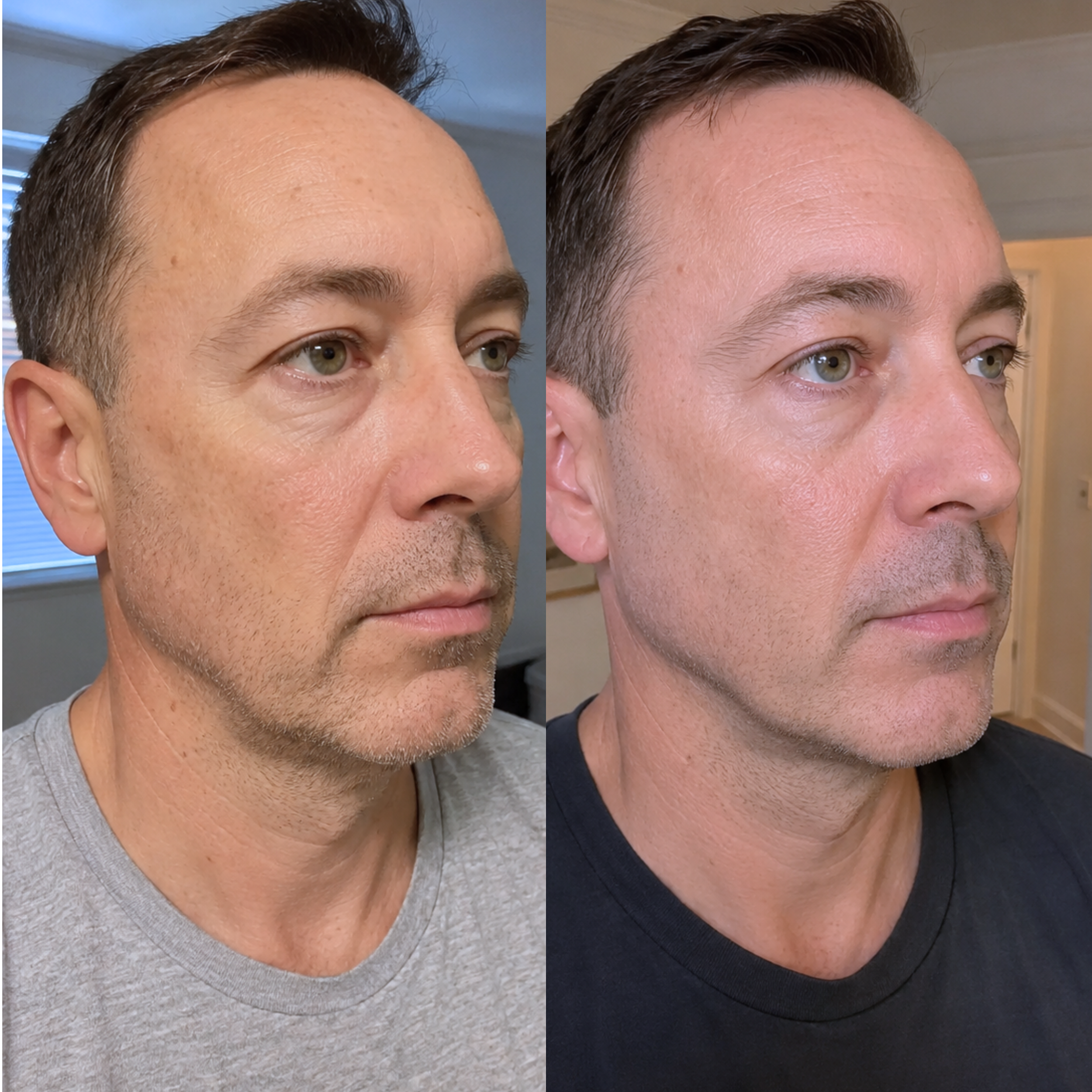 Comparison of a man's face before and after cosmetic treatment, showing smoother skin and fewer wrinkles on the right side.