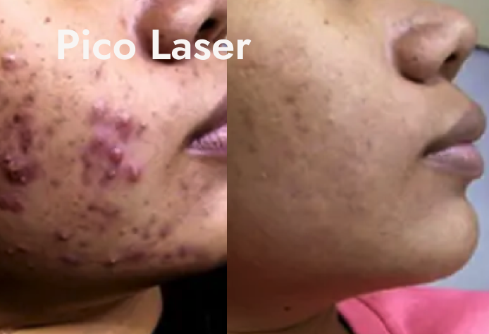 Comparison of a person's skin before and after Pico Laser treatment showing significant acne scar reduction.