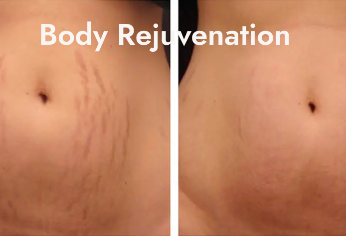 Before and after images of a person's abdomen showing reduction of stretch marks, with the words "Body Rejuvenation" overlayed at the top.