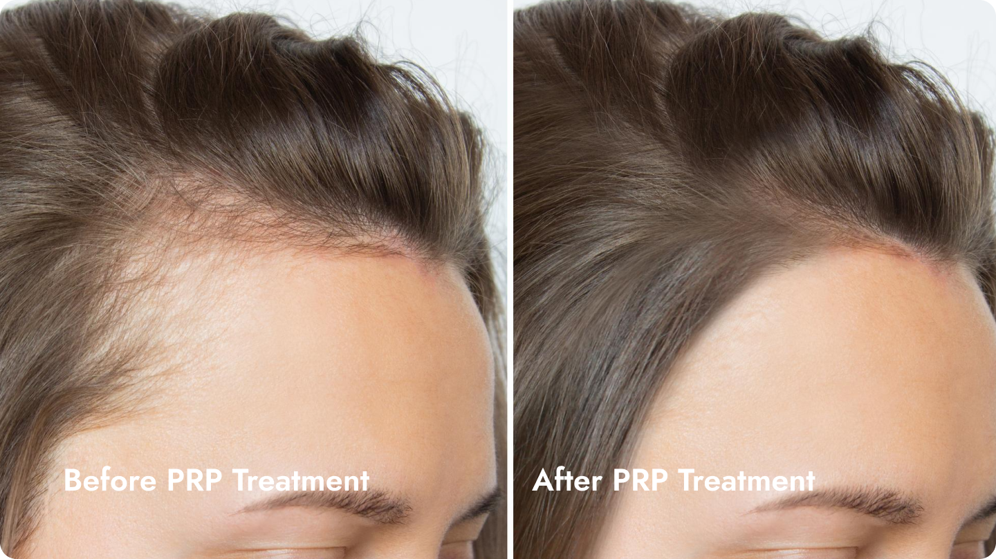 Side-by-side comparison of a woman's forehead before and after PRP treatment, showing improved skin texture and appearance.