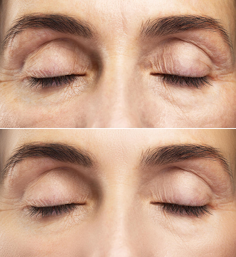 Close-up of a person's forehead and closed eyes before and after skincare treatment, showing improved skin texture.