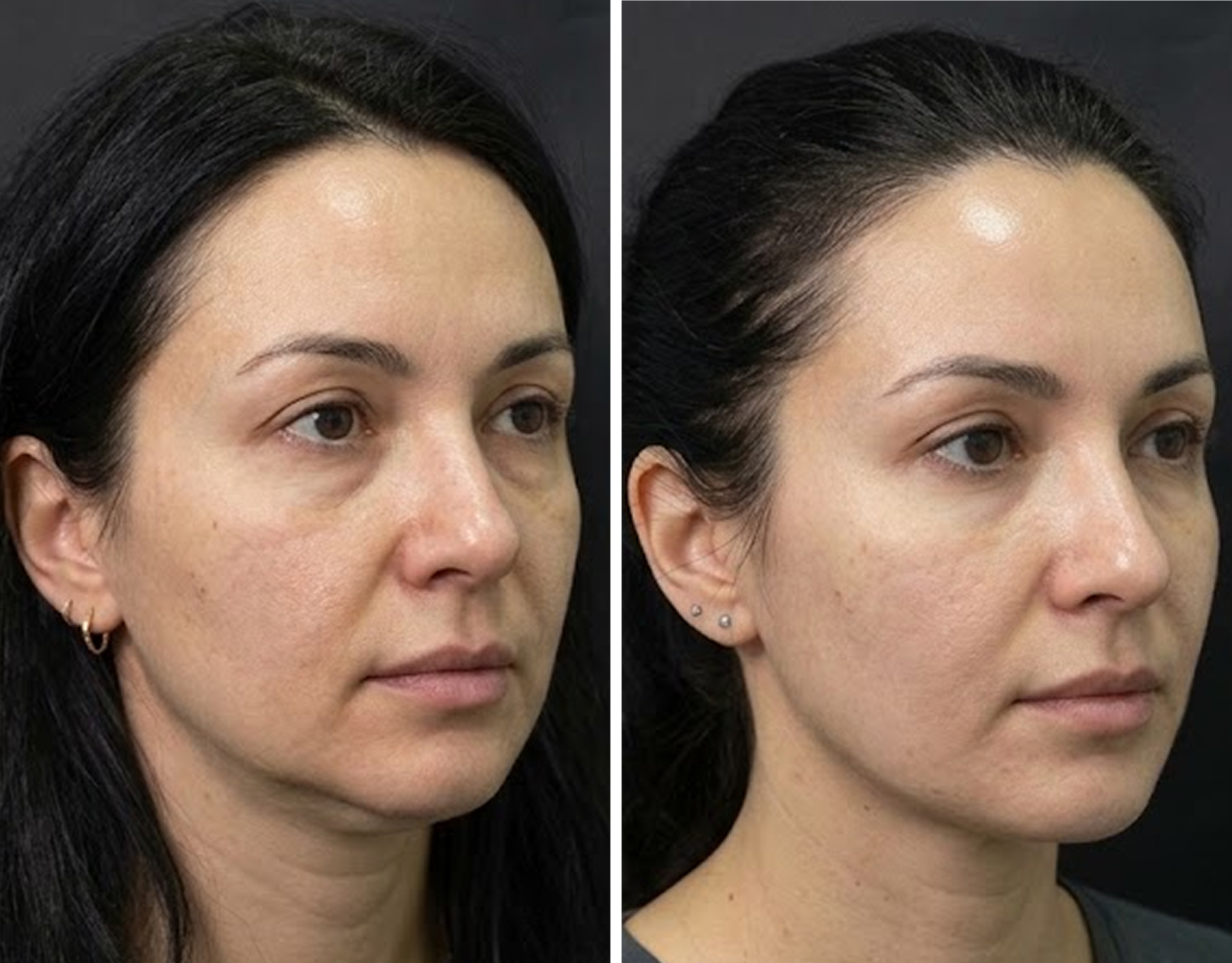 Comparison of a woman’s face before and after a skin treatment, showing improved skin texture and appearance.