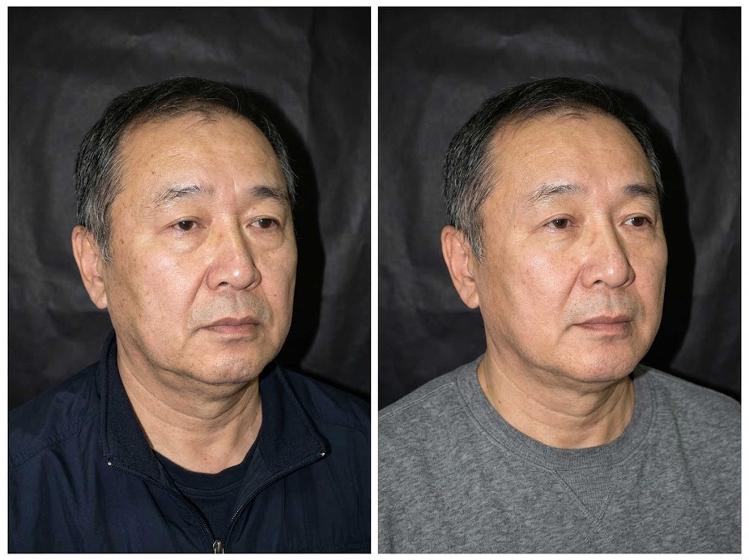 Comparison of a man’s face before and after a cosmetic treatment, showing improvements in skin texture and appearance.