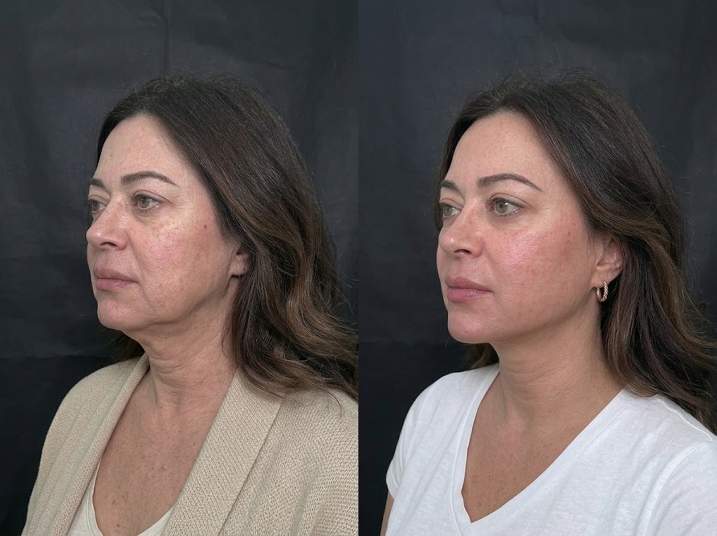 Before and after comparison of a woman's face showing skin improvement, with smoother skin and reduced wrinkles on the right side of the split image.