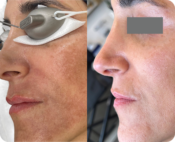 Side-by-side comparison of a woman's face before and after skincare treatment, showing clearer, smoother skin on the right side.