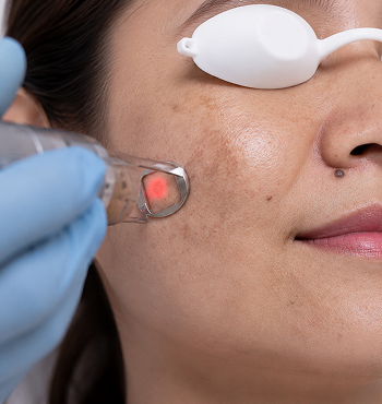 Close-up of a woman receiving a laser treatment on her cheek, wearing protective eye goggles, with a technician holding the laser device near her skin.