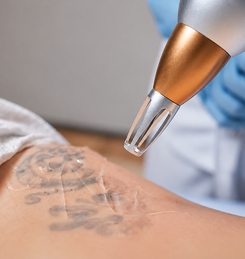 A laser tattoo removal device being used on a person's arm with a tattoo.