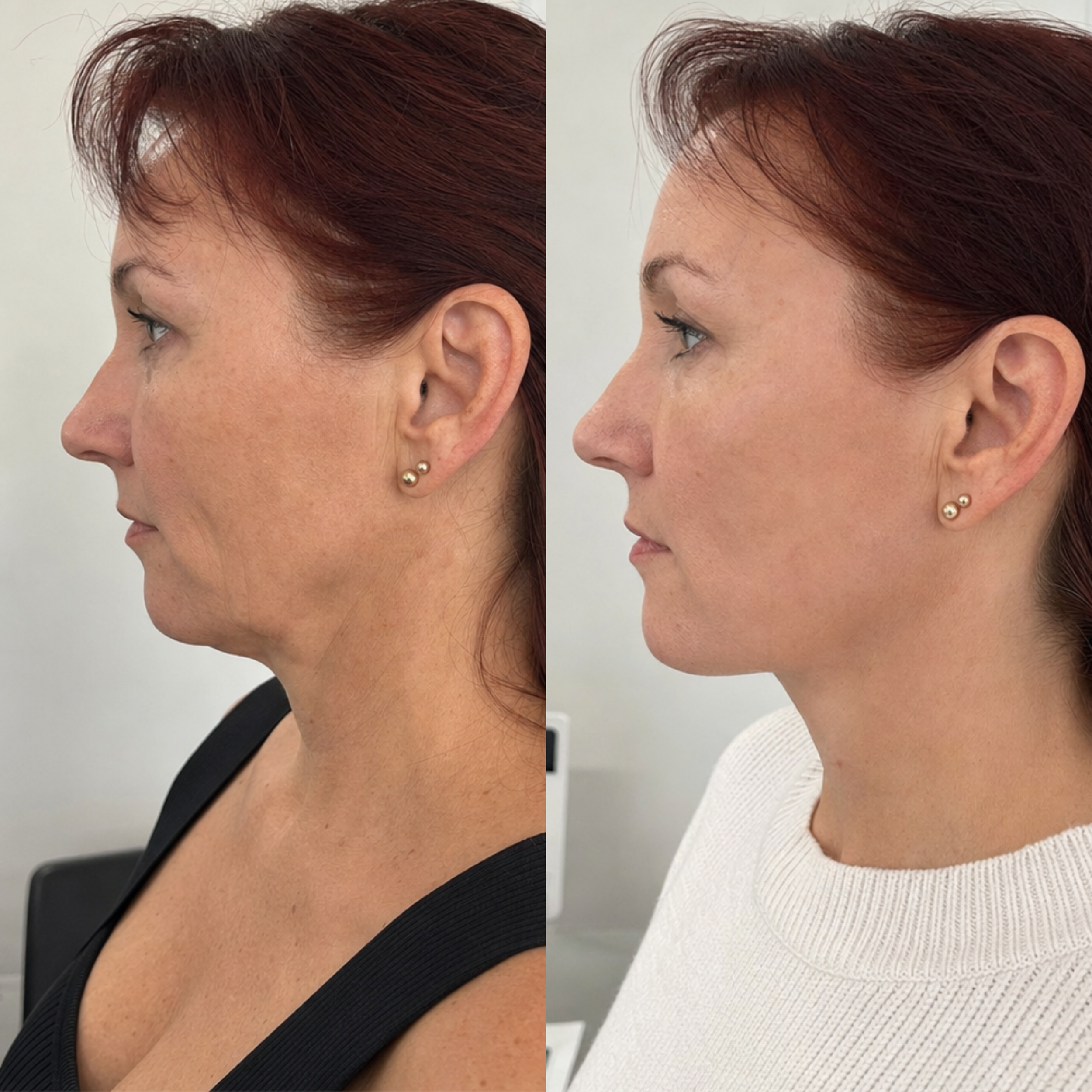 Side-by-side comparison of a woman's face showing before and after cosmetic treatment. The woman has reddish-brown hair and is wearing a black top in the left image, and a white top in the right image. The focus is on her cheek, jawline, and hairline