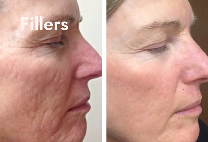 Side-by-side comparison of a woman's face showing before and after facial filler treatments, with the word 'Fillers' on the left side.