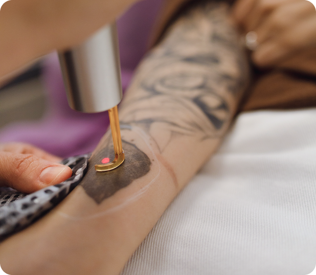 Tattoo removal laser treatment on a person's forearm.